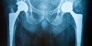 Hip Replacement Surgery