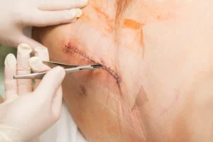 Hip Replacement Surgery