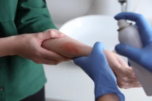 Scald Injury Cases
