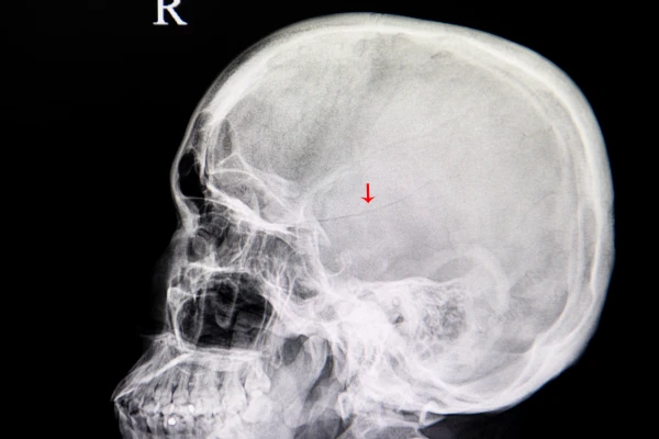 Skull Fractures