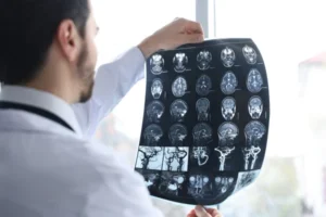 TBI Case