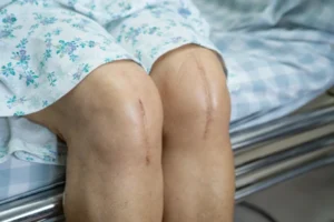Permanent Scarring and Disfigurement from Car Accidents