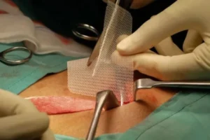 Hernia Mesh Legal Claims