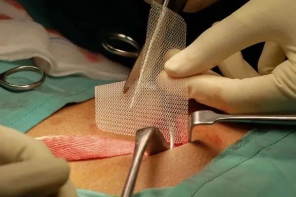 Hernia Mesh Legal Claims